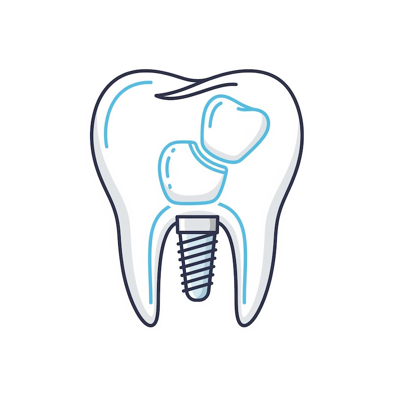 Icono Implantes de carga inmediata