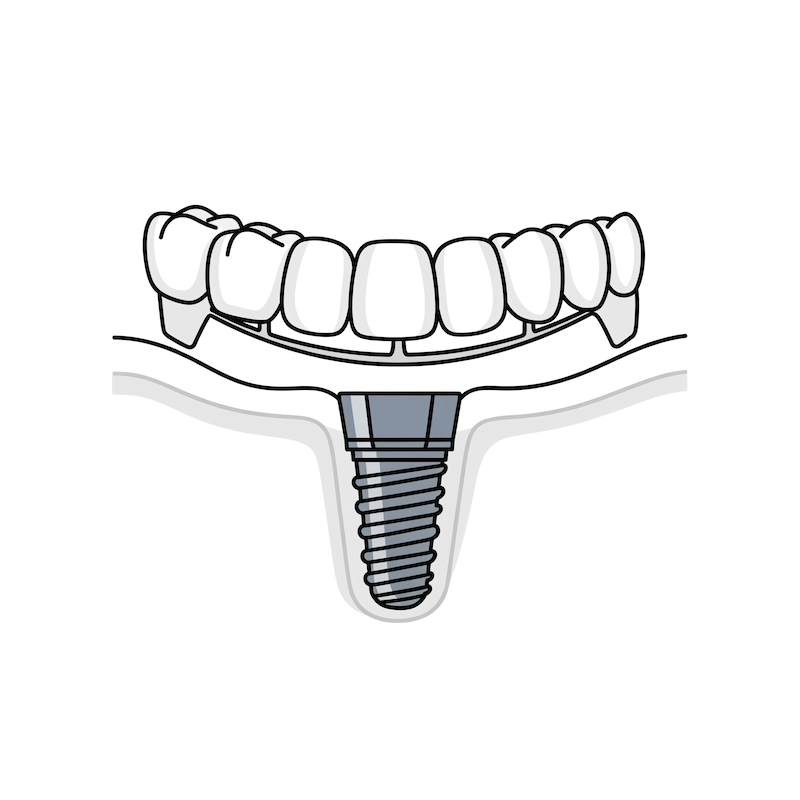 Icono Prótesis fijas sobre implantes